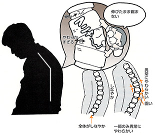 背骨の一部だけが異常に柔らかくなっている状態