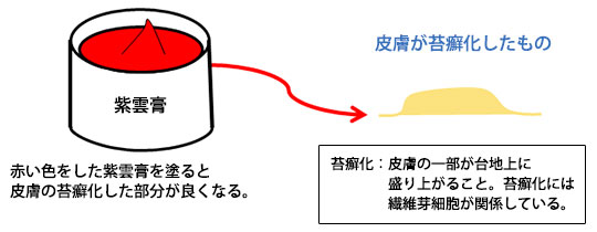 苔癬化した皮膚が紫雲膏でよくなった