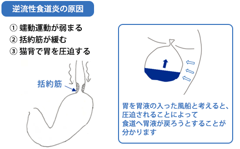 逆流性食道炎の原因