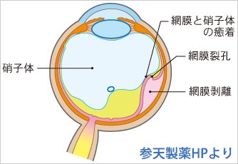 網膜剥離の図