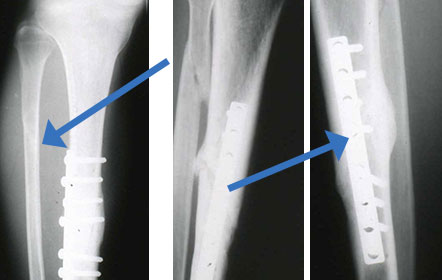骨折の治療例