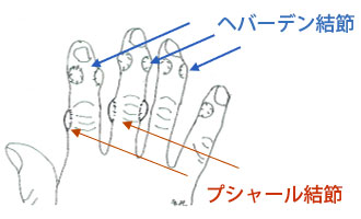 ヘバーデン結節とブシャール結節