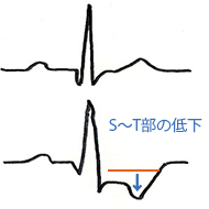 心電図での虚血の見方