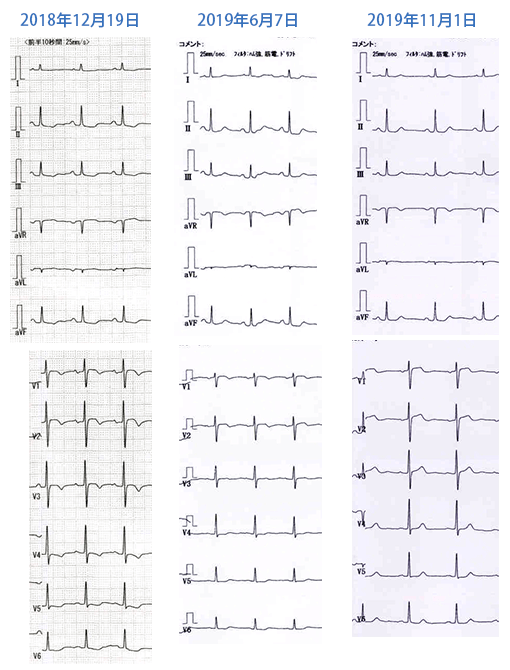 心電図経過