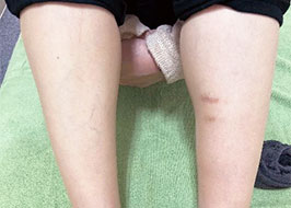 左下肢の内側の傷跡
