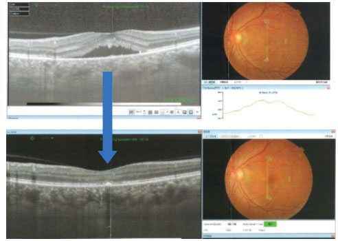中心性漿液性脈絡網膜症の治療前後