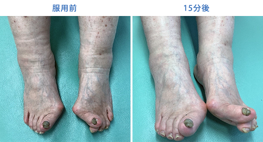 麻黄石膏を中心とする丸薬を投与する前と15分後の写真