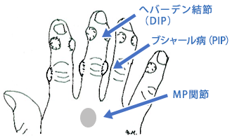 DIP 関節　PIP関節 　MP関節の炎症