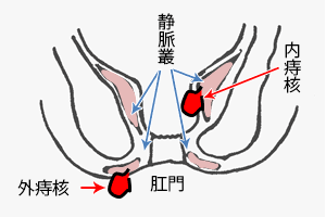 痔核（いぼ痔）