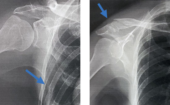 肋骨、肩関節周りのレントゲン写真