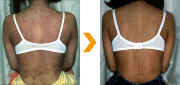 アトピー性皮膚炎、背中の治療症例