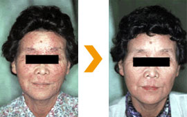 アトピー性皮膚炎、顔の治療症例