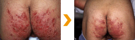 アトピー性皮膚炎、お尻の治療症例