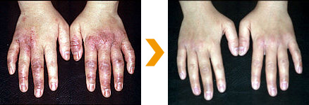 アトピー性皮膚炎、手の治療症例