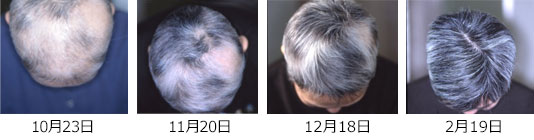円形脱毛症　治療症例1