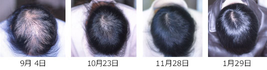円形脱毛症　治療症例3