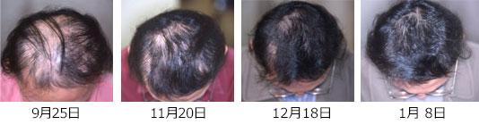 円形脱毛症　治療症例4