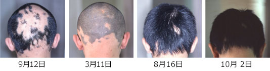 円形脱毛症　治療症例5