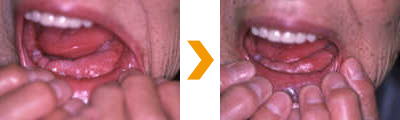 下顎がんの治療症例写真