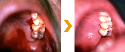 歯槽膿漏　治療症例