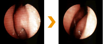 下顎がんの治療症例写真