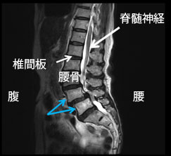 腰椎すべり症