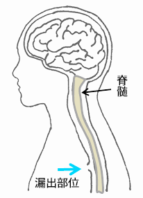 脳脊髄液減少症