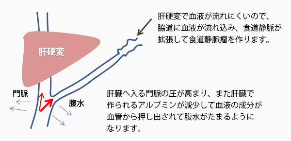 肝硬変の状態